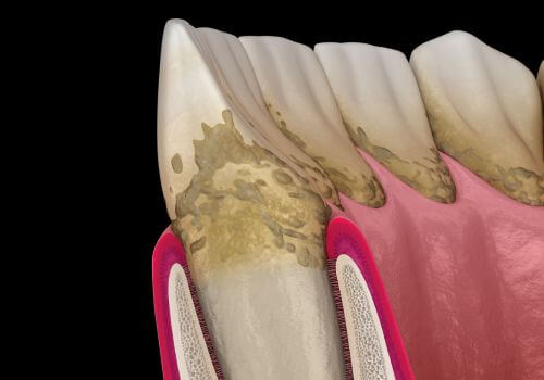 Plaque and tartar build on teeth along gumline